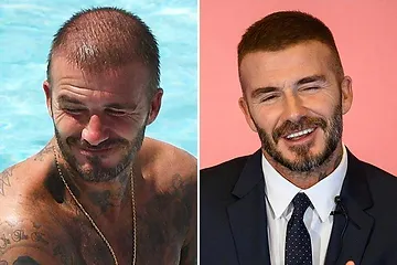 greffe-cheveux-david-beckham