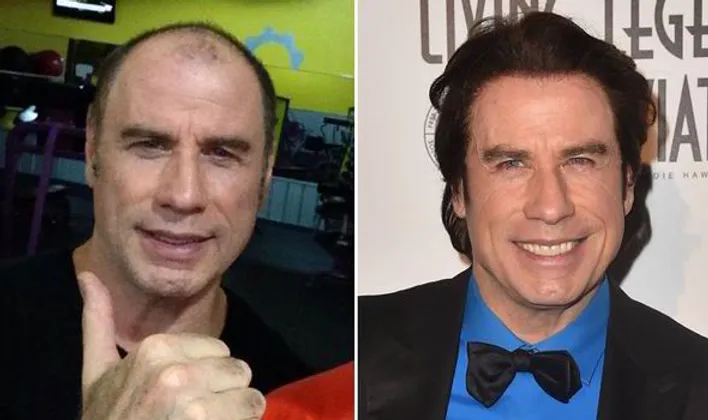 greffe-cheveux-john-travolta