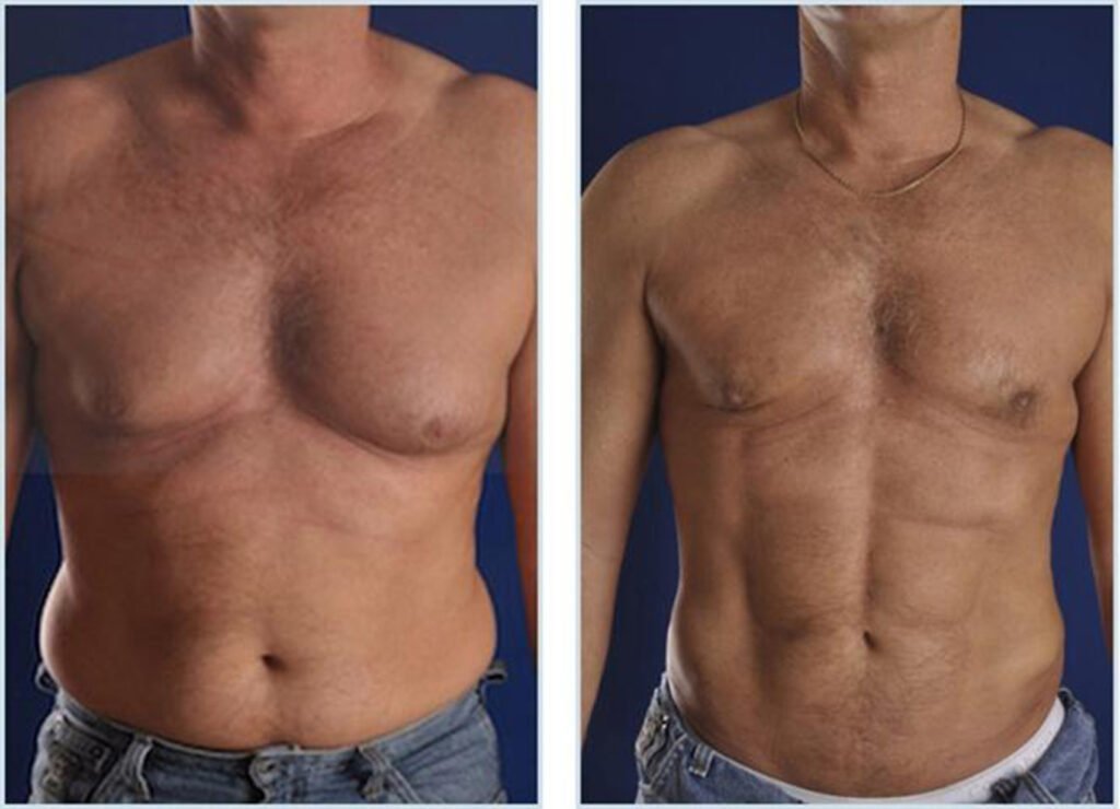 liposuccion-4d-istanbul-turquie